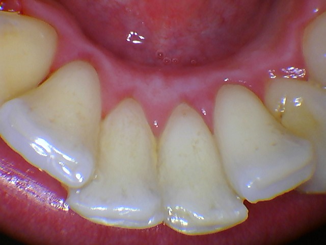 mouthwatch intraoral camera photo closeup